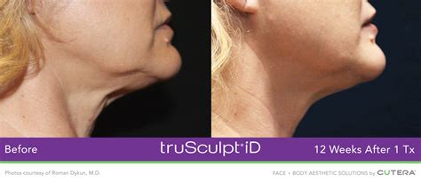 trusculpt id skin care